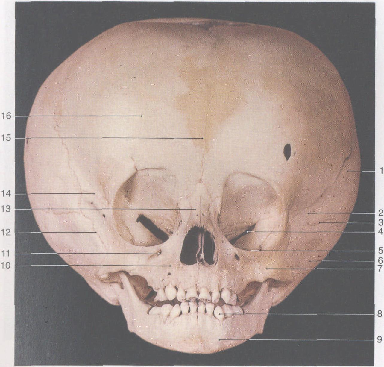 20. 小兒腦積水顱(前面觀)
